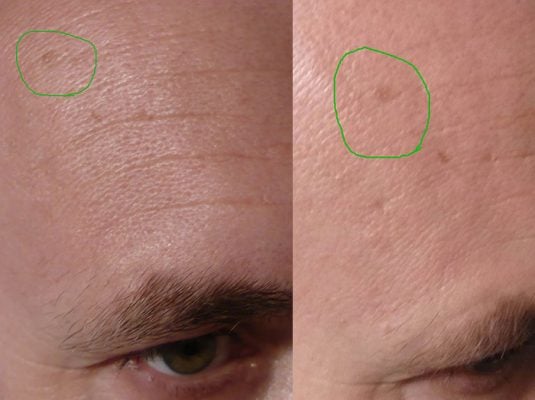 Rezultatele vindecarii cu Propolis 1 Miere Săbăduș tratament propolis Miere Săbăduș