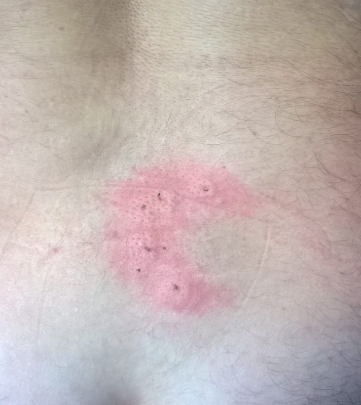Repetarea tratamentului cu venin de albine. 1 Miere Săbăduș tratament venin